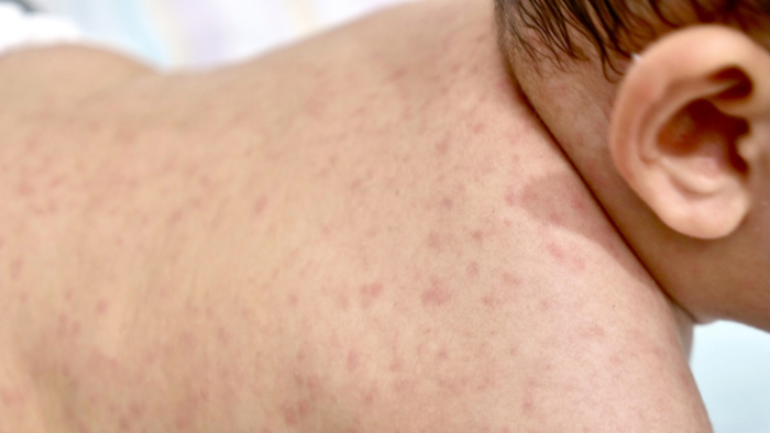 Bộ Y tế thông tin về các ca sốt phát ban, có 2 trẻ tử vong tại Quảng Nam