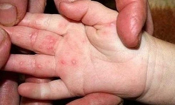 Hà Nội ghi nhận 282 ca mắc chân tay miệng, tăng 1,5 lần so với cùng kỳ